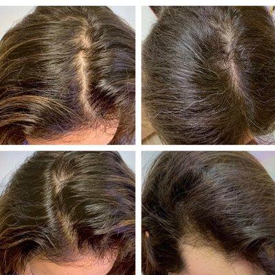 PRF for Alopecia