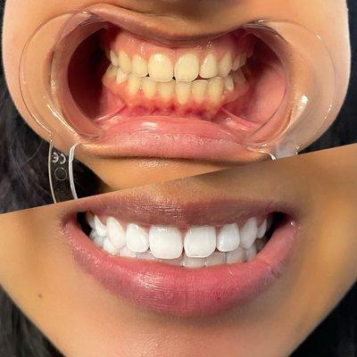 Teeth Whitening