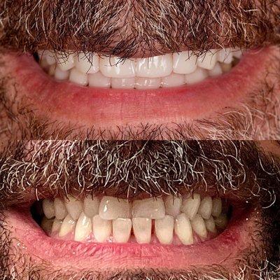 Correction of the teeth position, shape and color using porcelain veneers