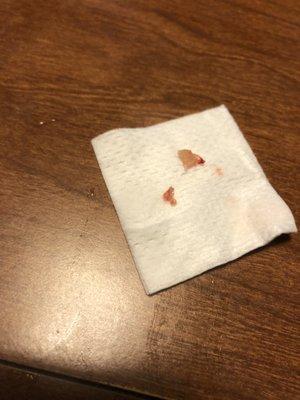 The fragment of my tooth left it in my mouth!