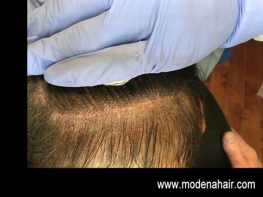 OC Scalp Micropigmentation