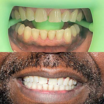 60 mins Teeth Whitening