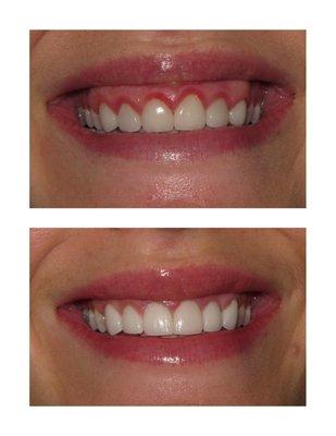 crown lengthening surgery before and after