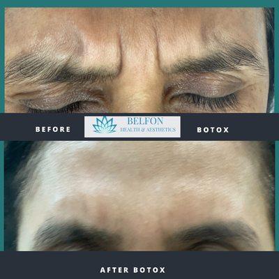 Botox for frown lines