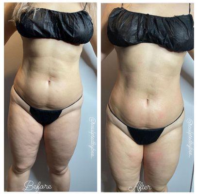 Tightened, Toned, and Shaped with just 1 Snatch that waist session ! 
 
 Sessions vary based on client goals and body type.