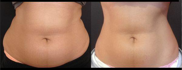 Body Contouring results