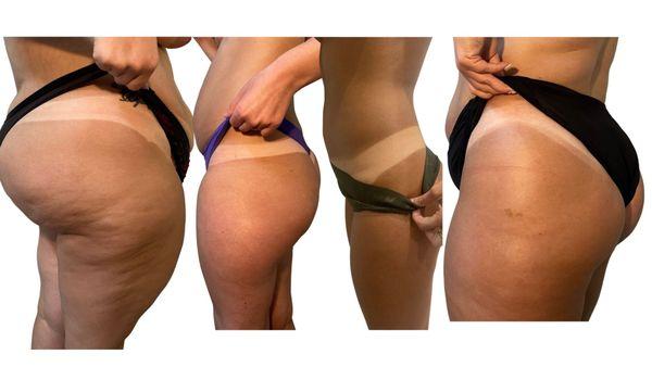 This is a variety of clients tan lines. We cater to everyone, all shapes and sizes. Everyone is beautiful