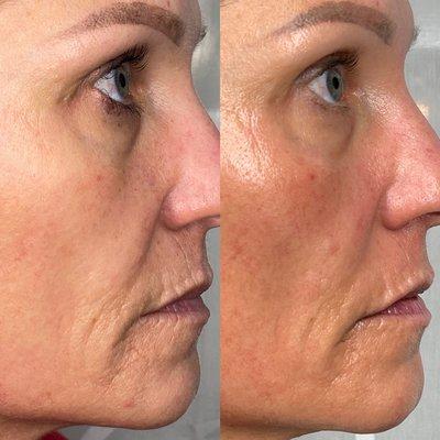 Microneedling results after 4 sessions