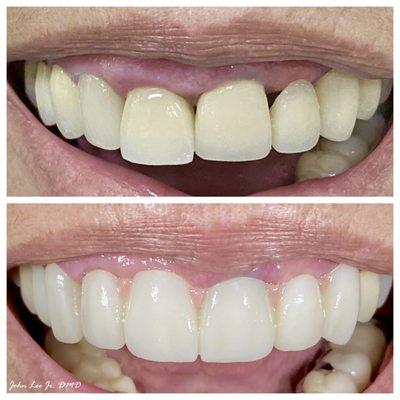 Challenging case due to the gum and bone loss surrounding this patient's front teeth. We utilized zirconia and some pink porcelain.