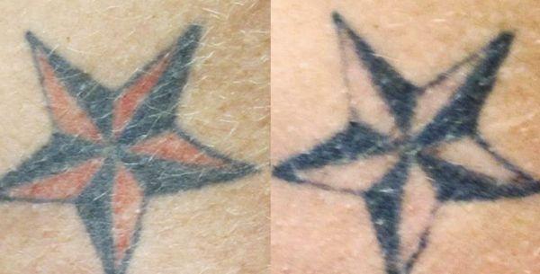 Tattoo Removal