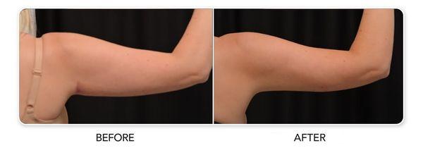 Before and after CoolSculpting® results on female arms