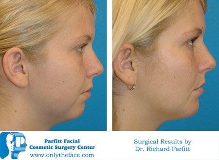 Fat Face -Buccal Fat Removal by Dr. Parfitt