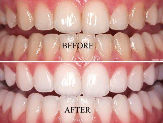 teeth whitening