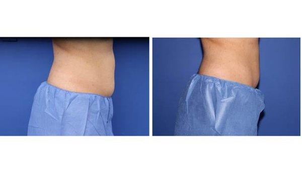 Before & After CoolSculpt