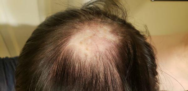 Bald spot, thinning fine hair. Darn near transparent.