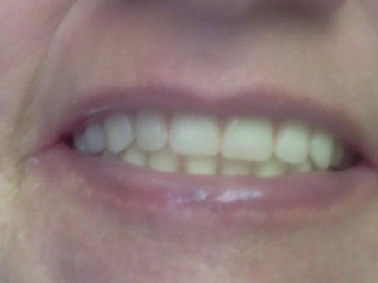 Beautyful dentures from my favorite dentist,,what a pretty smile i owe dr. Webber in springhill fl. My new smile.just alsome.