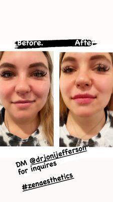 Lip Augmentation with filler