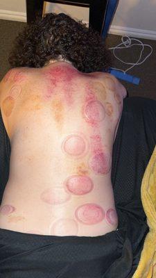 Cupping Therapy