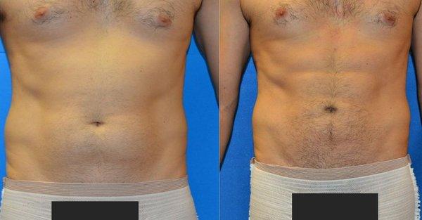 Abdominal and 'lovehandle' fat removal, with abdominal etching to sculpt and emphasize abdominal muscle definition.