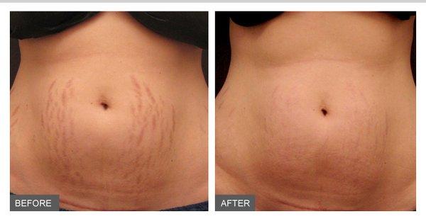 Micro-Needling for stretch marks