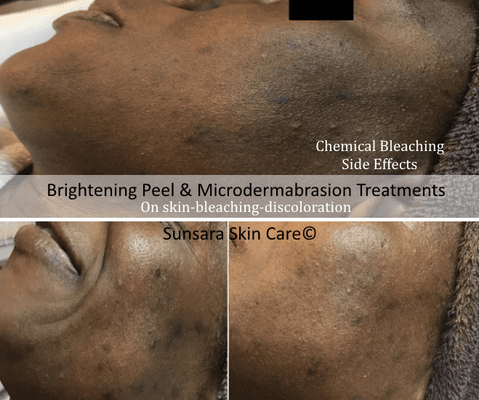 Brightening Peel + Microdermabrasion  Treatments