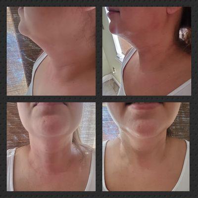 Therma-Lift lipolysis and jaw line contouring.