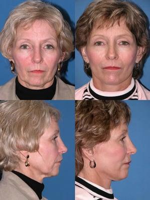 Facelift surgery before and after photo