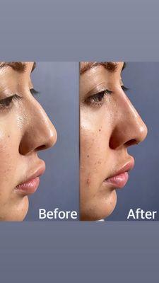 Liquid Rhinoplasty Before & After