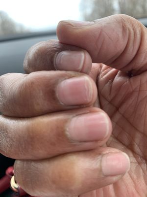 Weak peeling nails. I had to cut them down because everytime I picked up something they would bend and break.