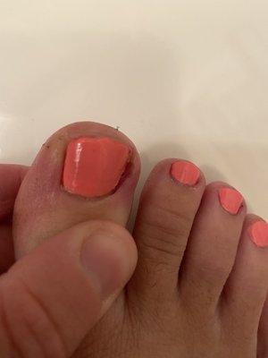 Swollen, painful toe