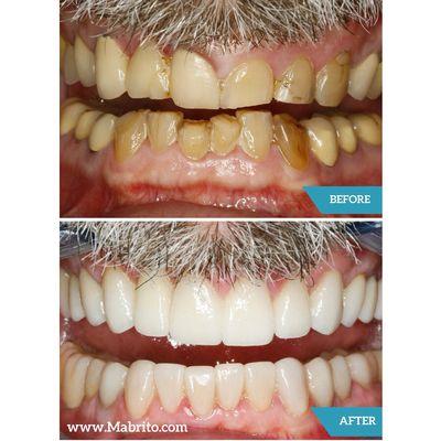 Before/After full mouth rehabilitation