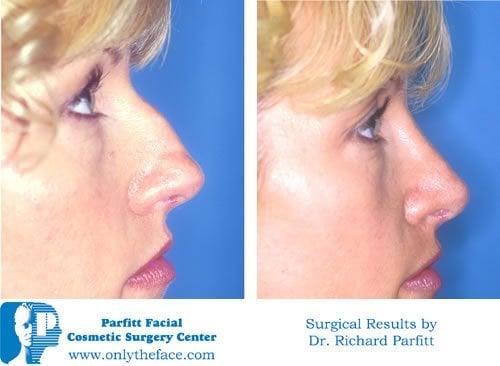 Rhinoplasty WI Facial Plastic Surgeon Dr. Richard Parfitt