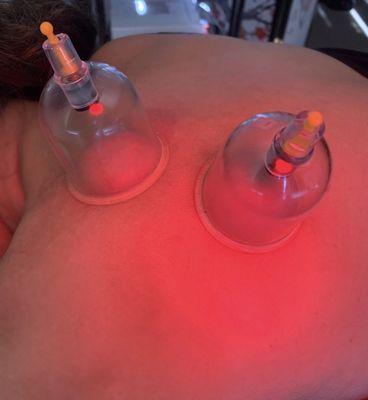 Cupping for shoulder and upper back pain