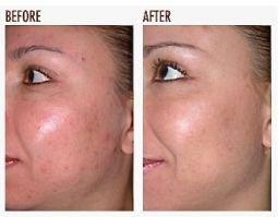 acne spots, discoloration