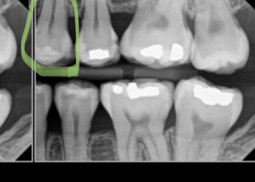 Second of two teeth recommended to crown. Both teeth just needed chipped-off fillings replaced.