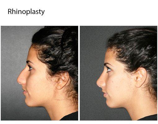 Rhinoplasty