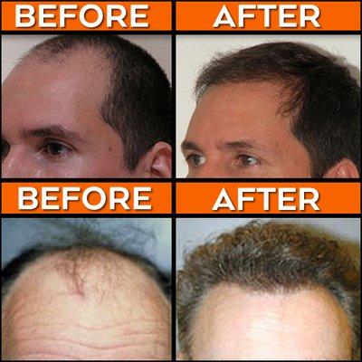 We offer NeoGraft, a minimally invasive, automated hair restoration procedure that produces less-invasive results without linear scarring.