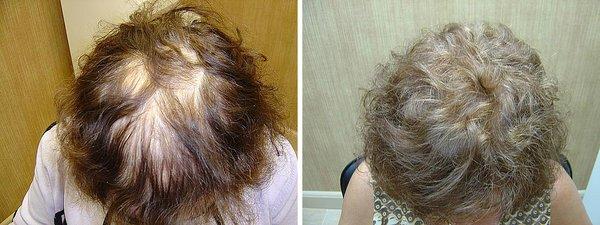 Hair restoration Before and After