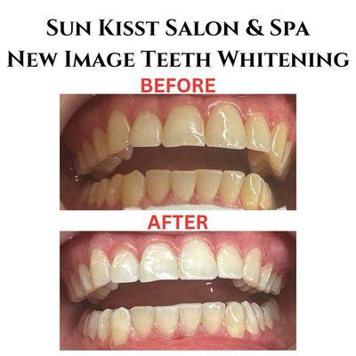 Teeth Whitening Available