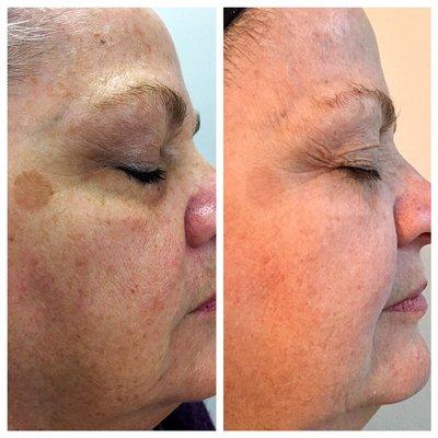 Phenomenal results after just ONE treatment with our ICON laser! Two treatments left. (Photos are not retouched)