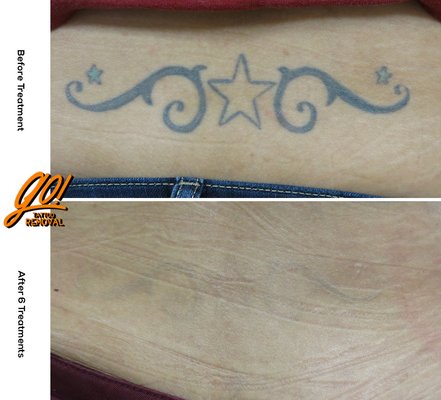 Near full removal on a lower back tattoo