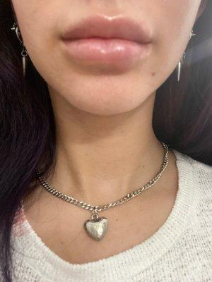 After 2 weeks lip filler