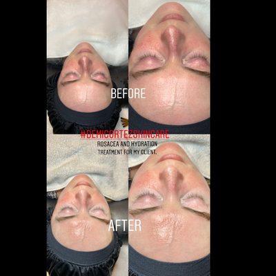 Rosacea treatment