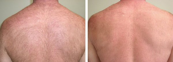 Laser hair removal for men.