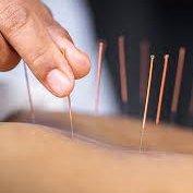 Acupuncture Sale Save 20% new clients