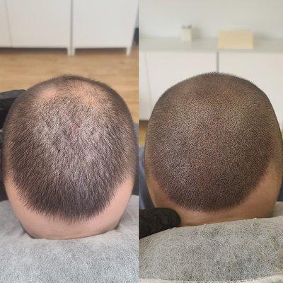 Scalp Micropigmentation thinning hair new Braunfels results smp location clinic msp Vinci