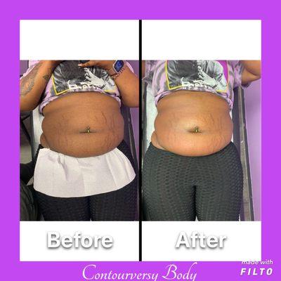 Immediate results from our "too waisted" combo deal. The "too waisted" combines cavitation and laser to sculpt waist and back.