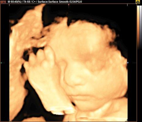 Hello Baby 3D/4D Ultrasound