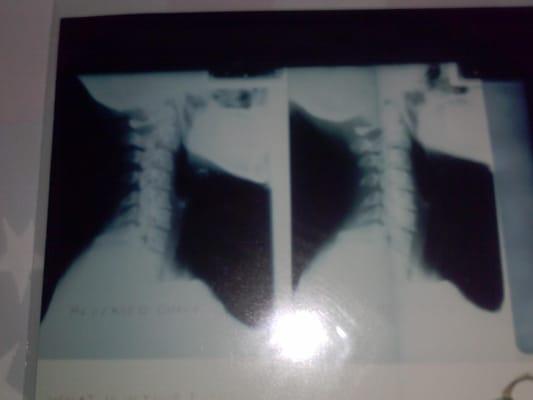 Arthritis and disc herniation repair proven by before and after x-ray by Dr
Clay Robert Miller! NO MORE PAIN!!