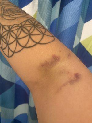 Bruised still healing from july 21st